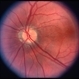 Peripapillary Atrophy